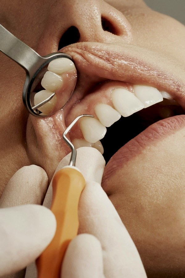 Tratamento de gengiva (periodontia) na Iso Angra