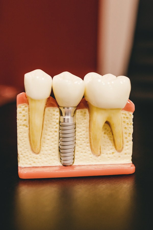Implantes dentários na Iso Angra